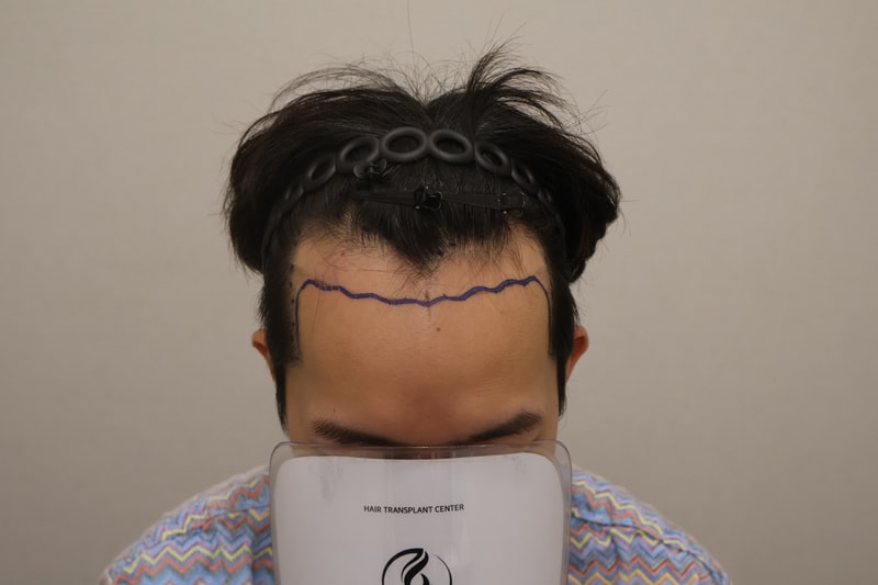 동탄 헤어로의원 3800모 9개월 경과 후기