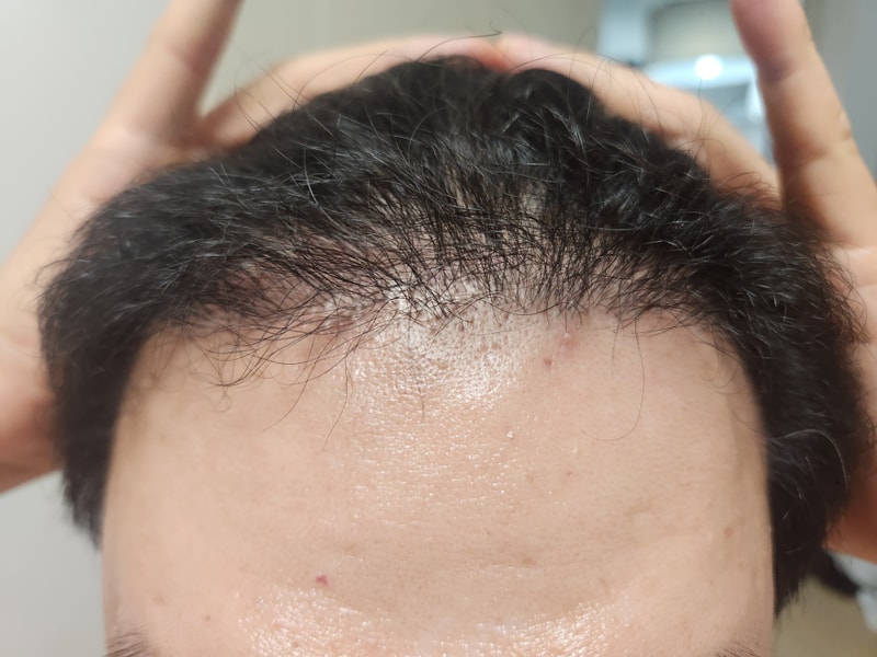 [뉴헤어] 6개월 후기 (비절개 1500모낭)