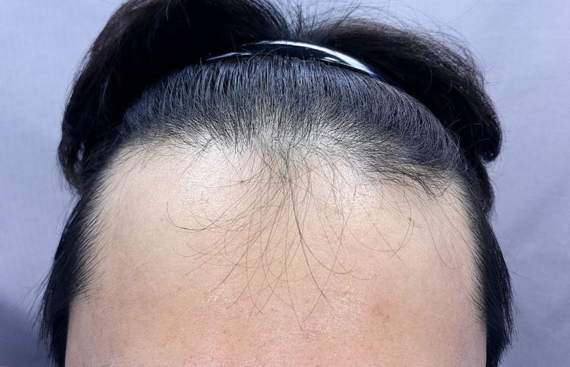 헤어라인 가르마 1500모낭 이식