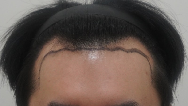 Dr. Park Sang-hyun, a review of the M-shaped Hair Transplant day in his mid-20s.