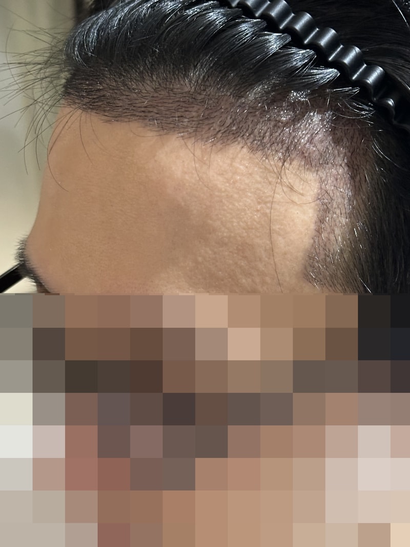 (2주차)모원성형외과 1700모낭 (현미경 이식) 비절개 무삭발 이식 후기입니다.
