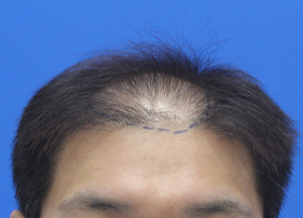 I'm finally writing a review of the 3,000-mo Hair Transplant for a year.
