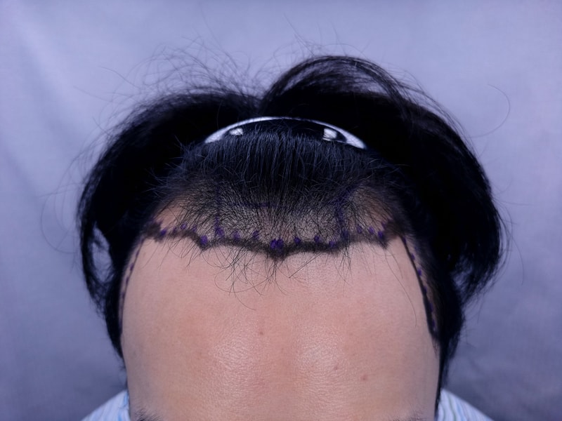 모발이식 포토후기