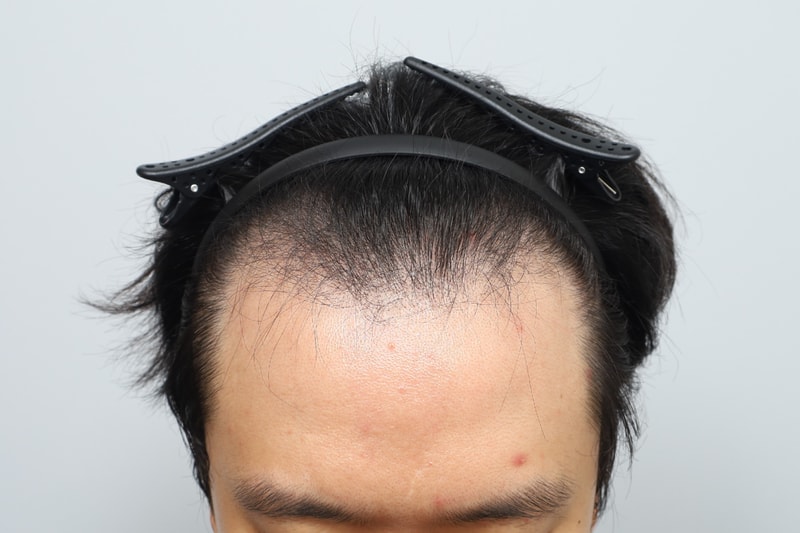 모원성형외과 m자이마 헤어라인 모발이식 1800모낭 무삭발 비절개 7개월차