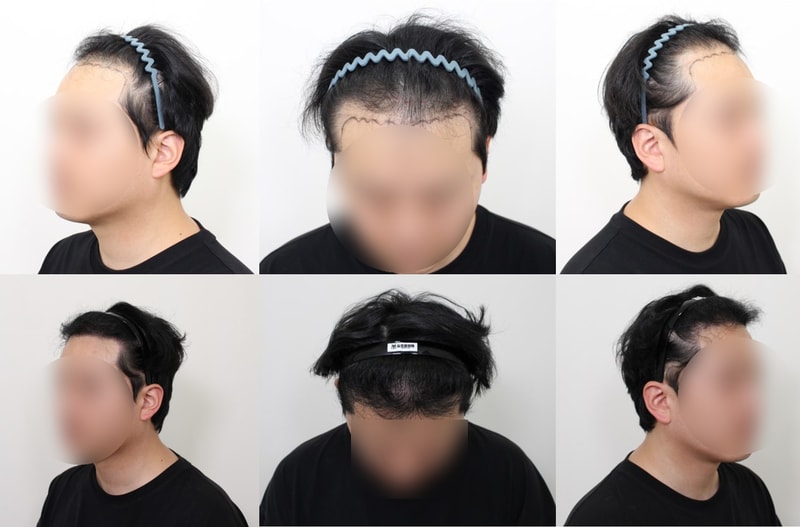 모프로의원 모발이식 6개월차 후기