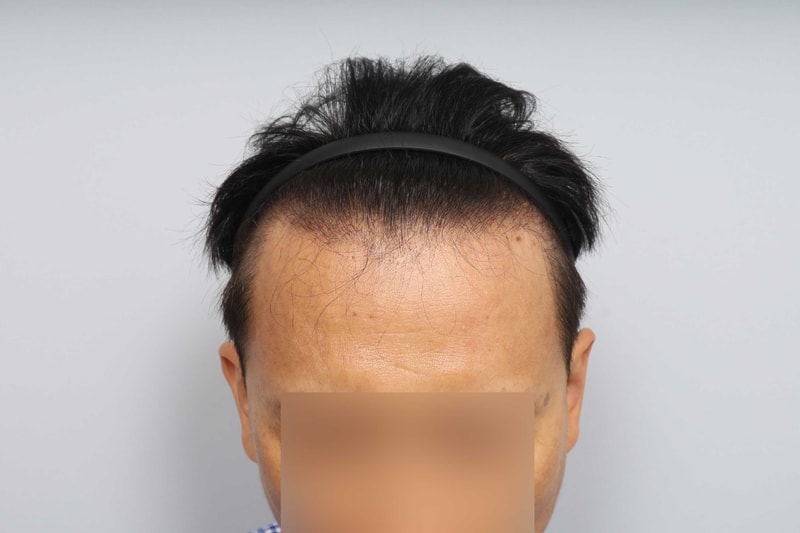 Reoperation of the MO.1 plastic surgery 1800 hair follicle non-excision Hair Transplant 7 months old