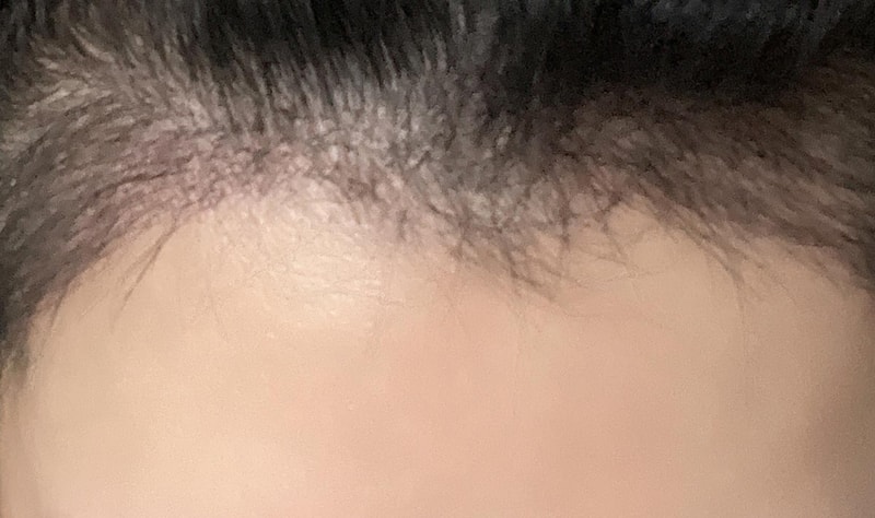 루트테마 비절개 모발이식 한 달