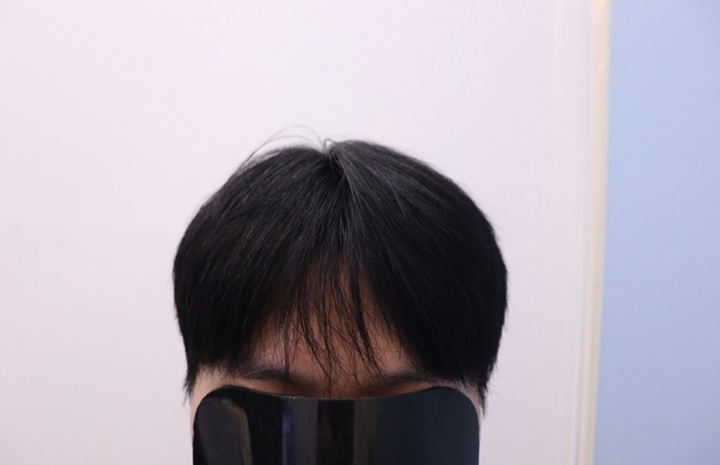 광주 압구정모비앙의원 모발이식 10개월 경과 후기