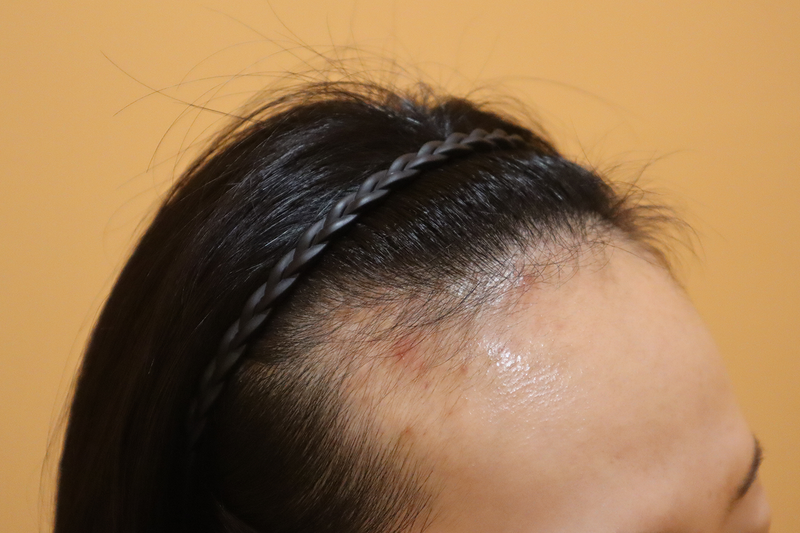 HAIRO HAIR TRANSPLANT CENTER Busan non-cutaneous 1600 hair follicles for 7 months