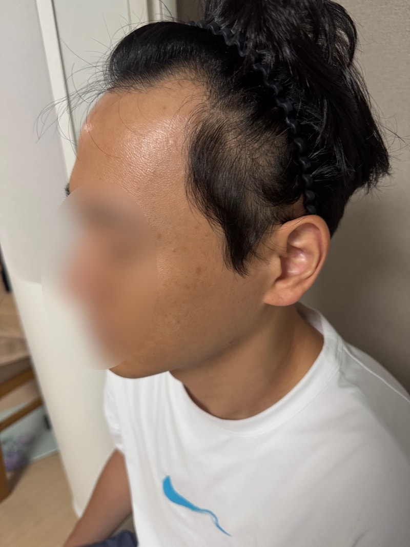 1700모낭 투블럭 비절개 모발이식 4개월 후기 모원성형외과