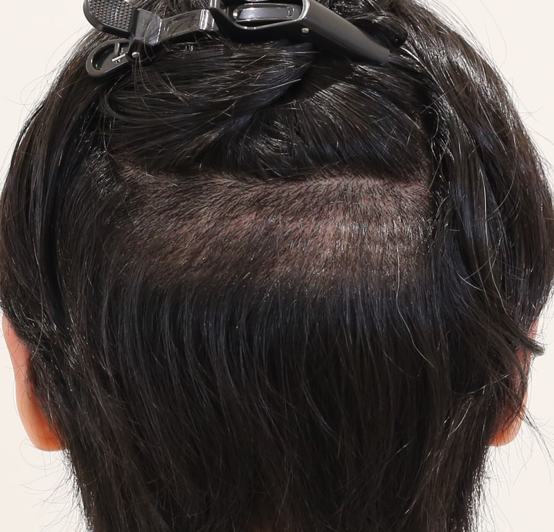 오형석 2주 후두부.JPG