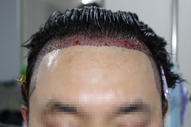 수술당일 디자인(정면1).jpg
