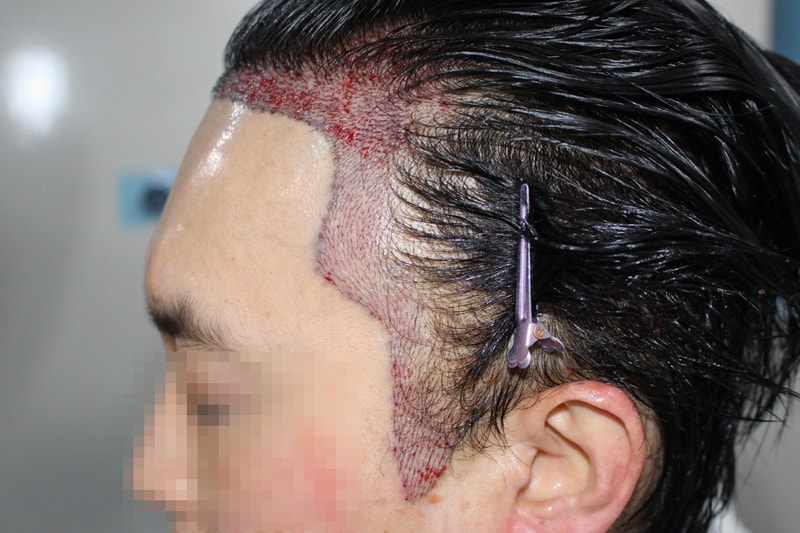 수술당일 디자인(측면1).jpg