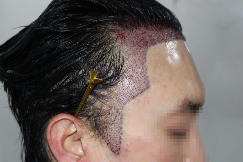 수술당일 디자인(측면2).jpg