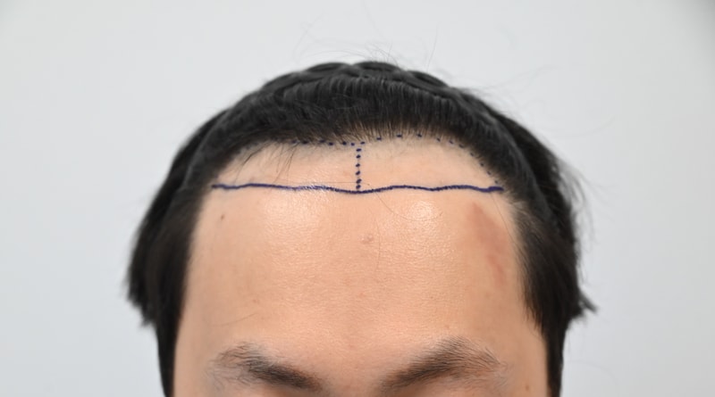 [MOEM Clinic] This is the review of the 3,500-mo non-cutaneous Hair Transplant by Director Yong-wook.