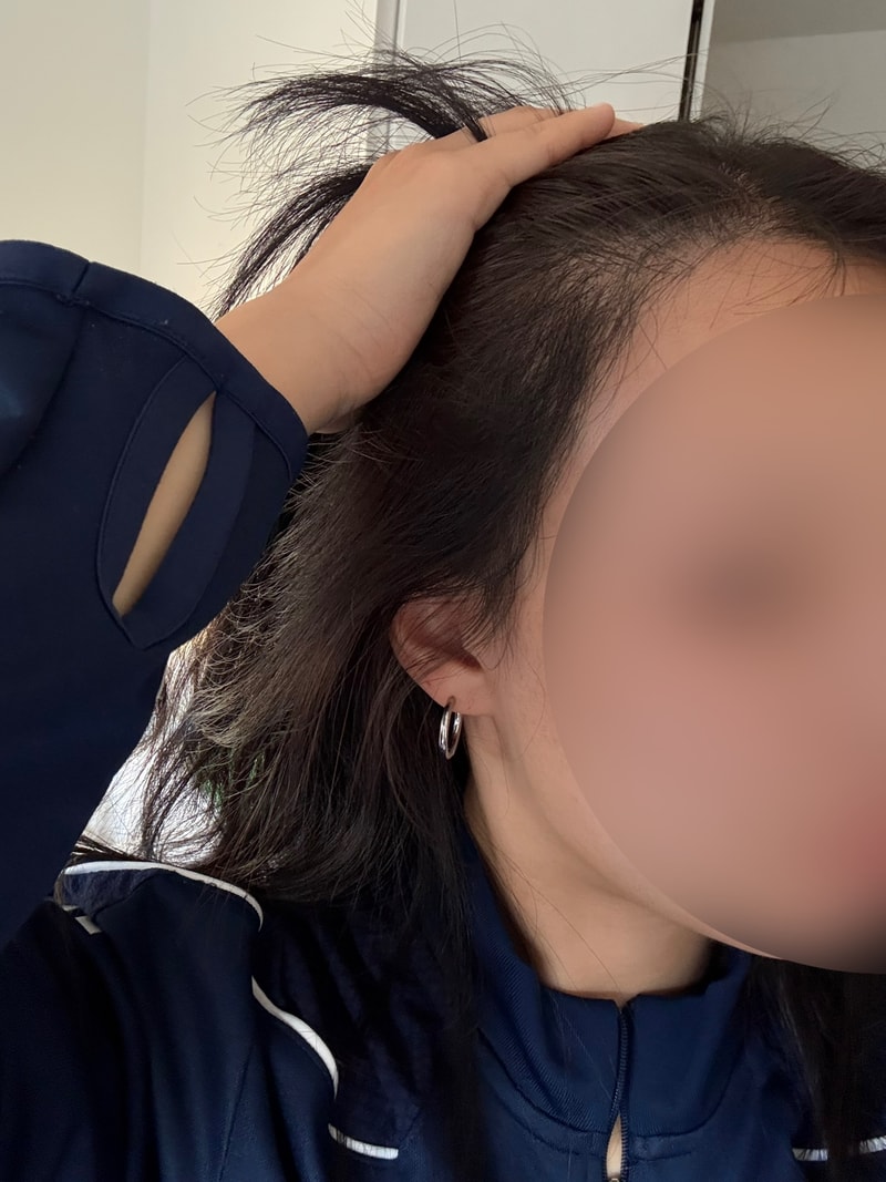 신사역 모프로의원 헤어라인 교정 6개월차 후기