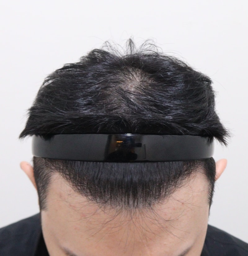 5. 수술후_1년_2.JPG