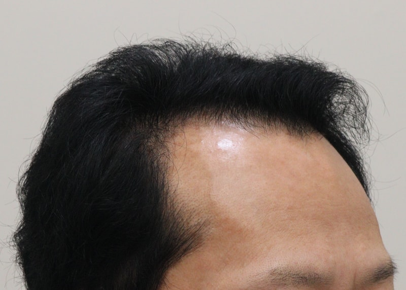 1. 수술전_3.JPG
