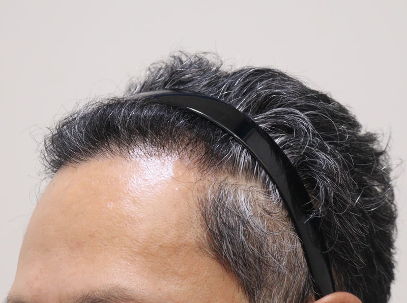 3. 수술후_6개월_3.JPG