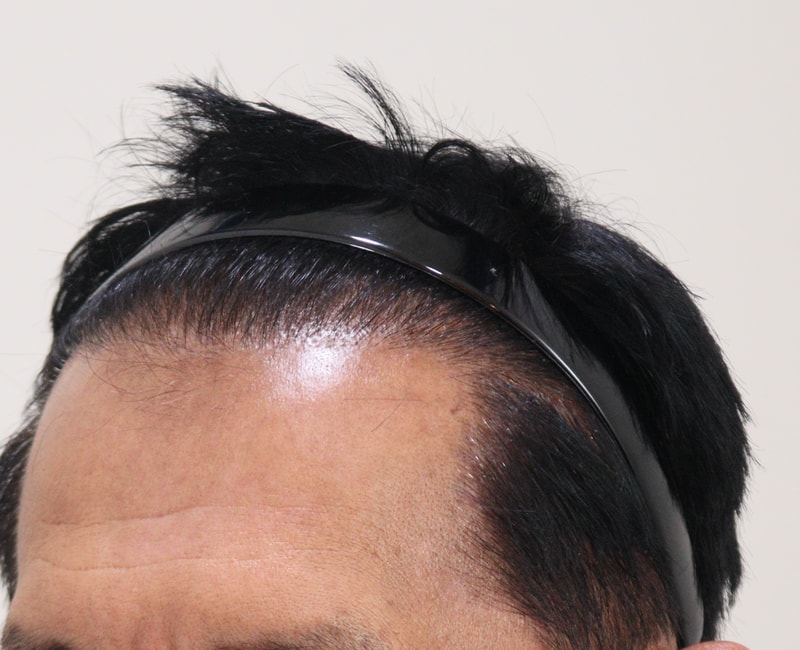 4. 수술후_7개월_2.JPG