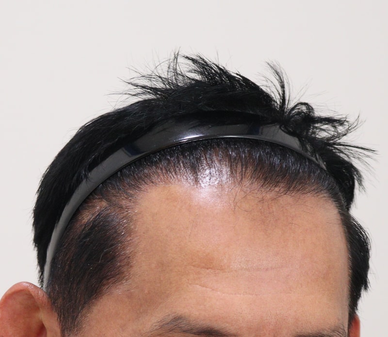 4. 수술후_7개월_3.JPG