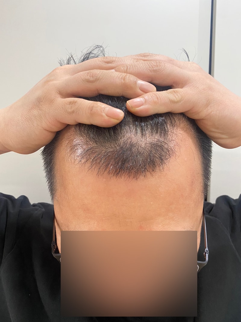 엠자이마 헤어라인 2377모낭 비절개 모발이식 모원성형외과 1년차
