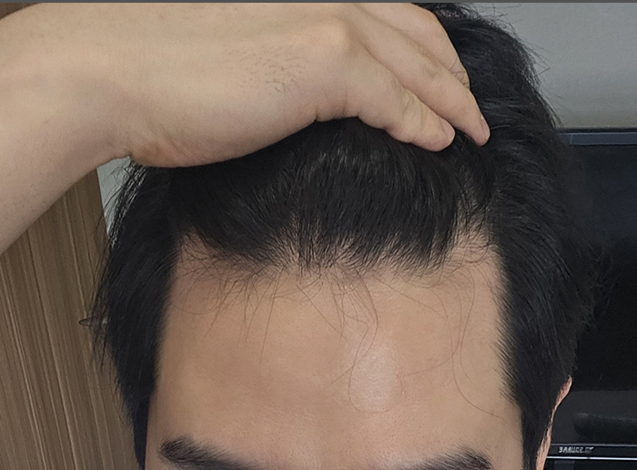 모플러스 성형외과 비절개 모발이식 무삭발 2000모 7개월 넘은 후기