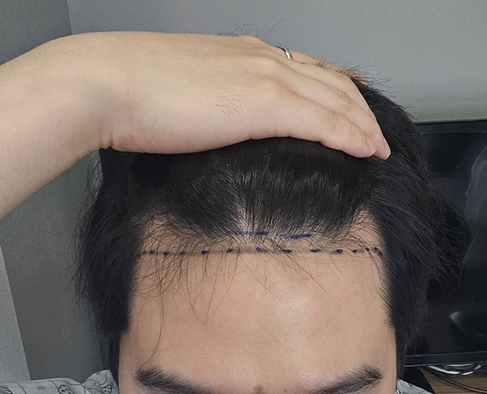1-디자인그리고 잠깐 회복실에서 대기할때 찍음.jpg