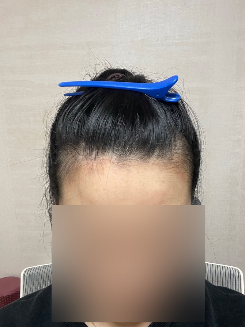 MO.1成形外科医院 ヘアライン 植毛 1200毛包 3か月目 パク・ジョンオク院長