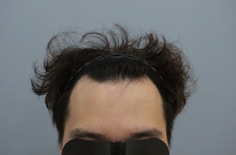 Review after 10 months of Gwangju apgujeong mobien Hair Transplant