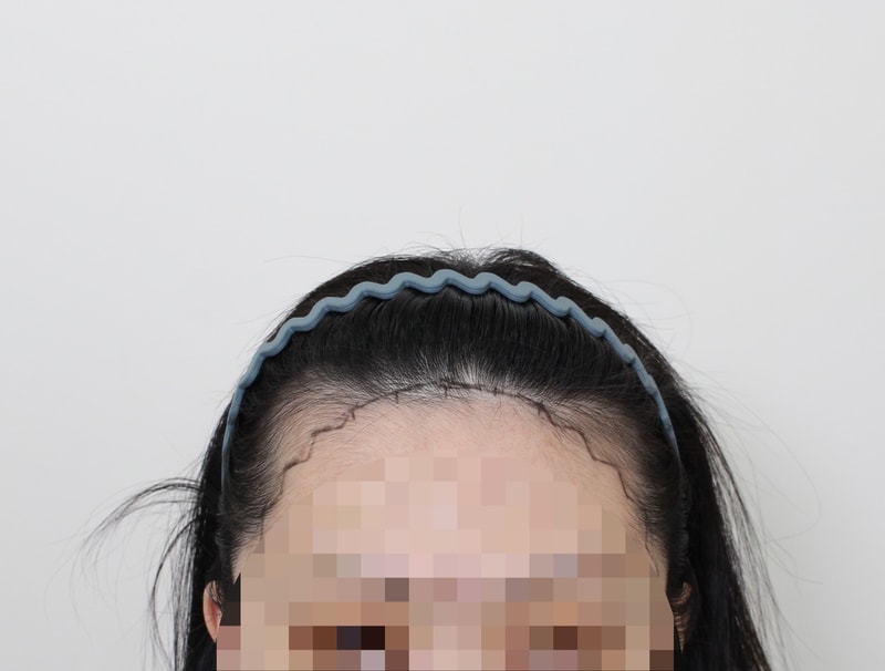 신사동 모프로의원 (문건학 대표원장님) 헤어라인 이식 2주차 경과