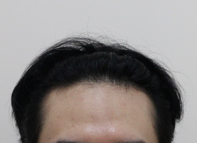 모앤블레스 모발이식 1년후기입니다!