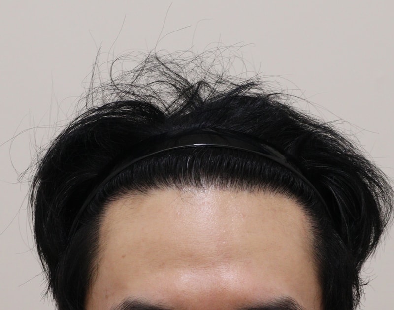 5. 수술후_1년_1.JPG