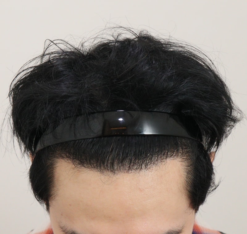 5. 수술후_1년_2.JPG