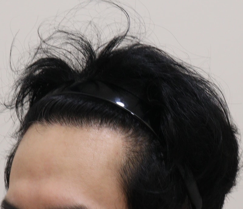 5. 수술후_1년_3.JPG