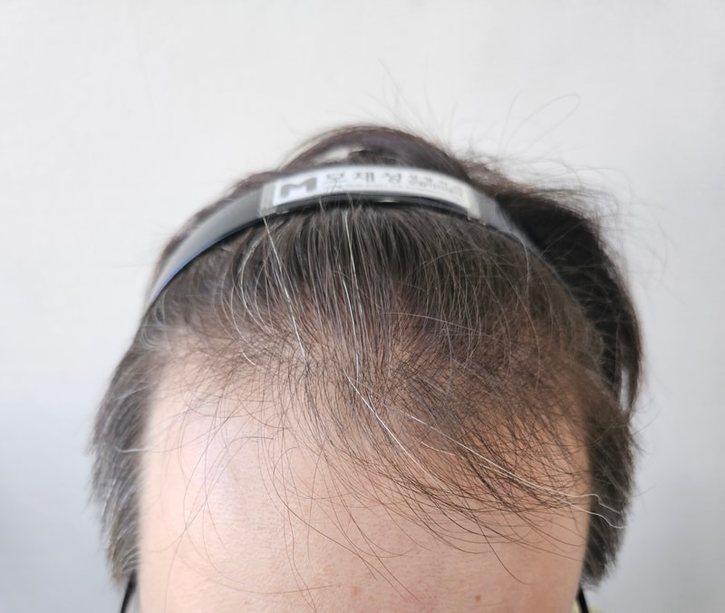 This is a review from immediately after the parent Hair Transplant to the second week.