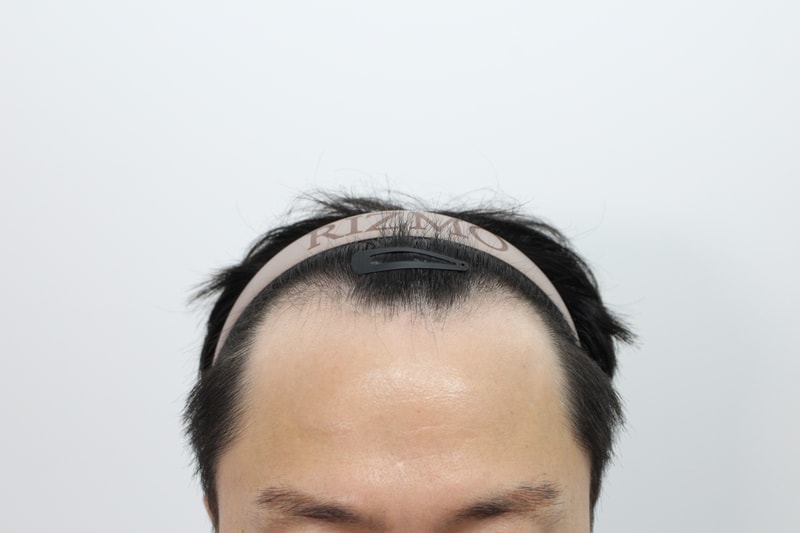 부산리즈모의원 모발이식 8개월경과