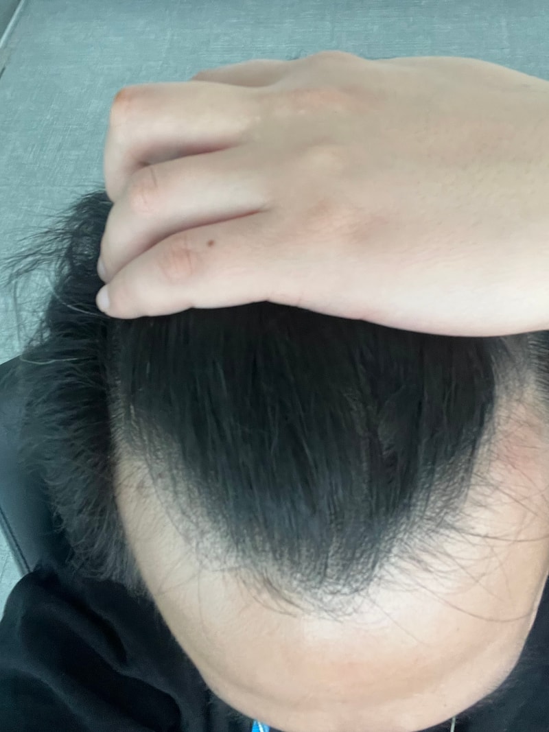 모발이식 3000모 후기