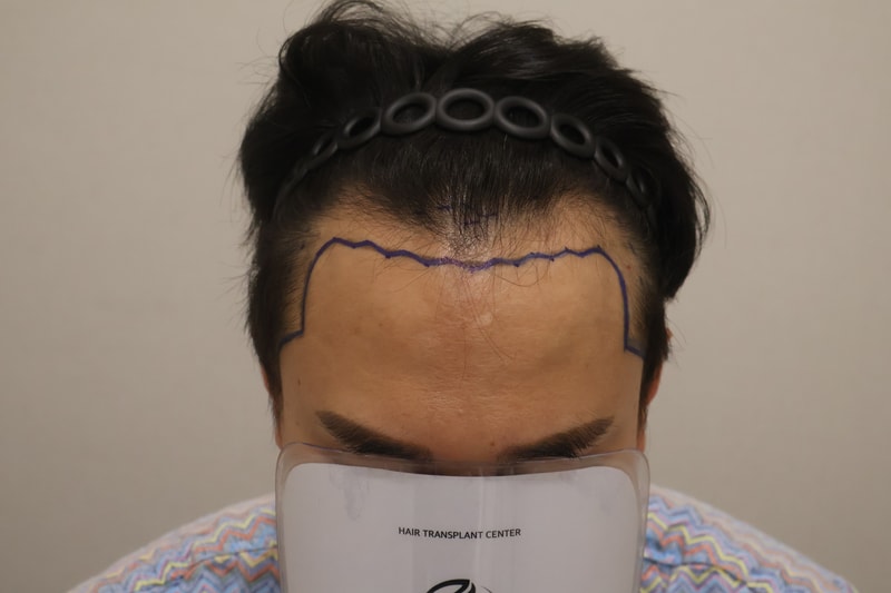 동탄 헤어로 3700모 9개월 경과 후기