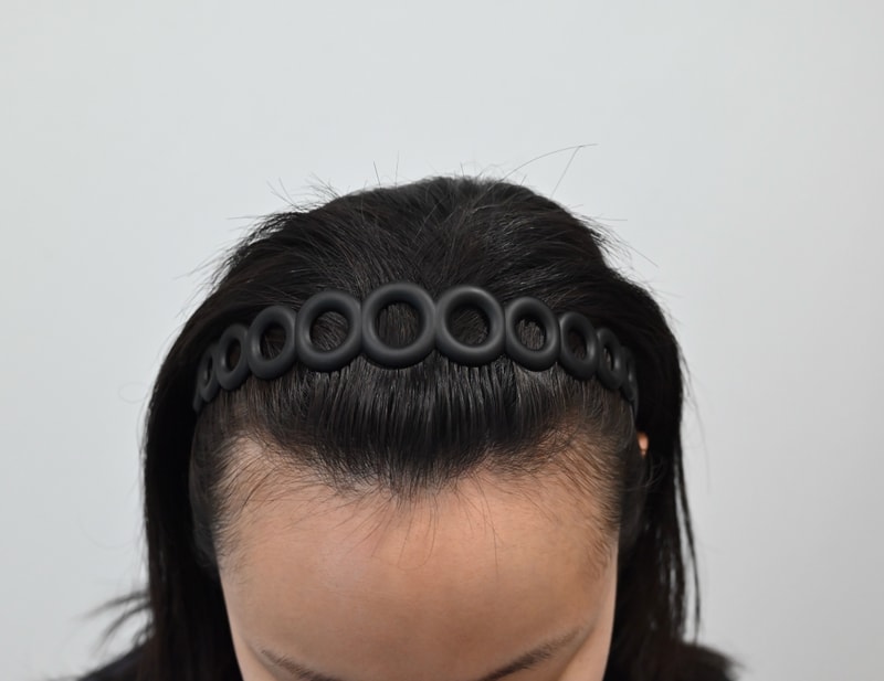 Women's hairline Hair Transplant 3500 Mo 13th day review
