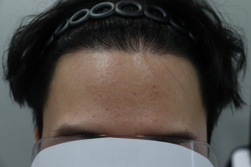 정승현_9개월경과 (19).bmp