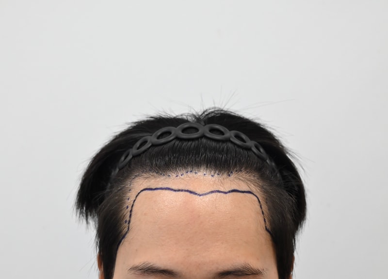 비절개 모발이식 이마라인내리기 1일차 후기 (모엠의원 전지훈 원장님)
