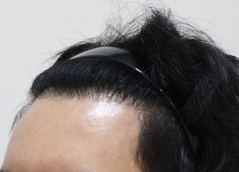 4. 수술후_1년_4.JPG