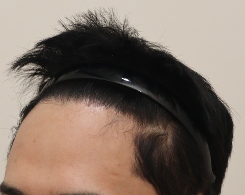 4. 수술후_7개월_3.JPG