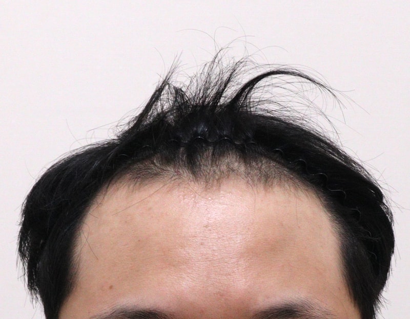 모발이식하길 너무 잘한거같습니다!!!