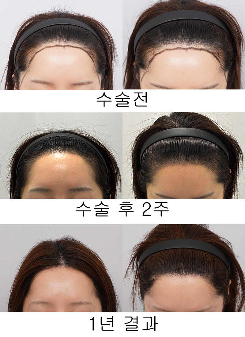 부산모발이식잘하는곳 모모 부산점 고상진원장님께 절개 2200모  수술 받고 1년 지났어요