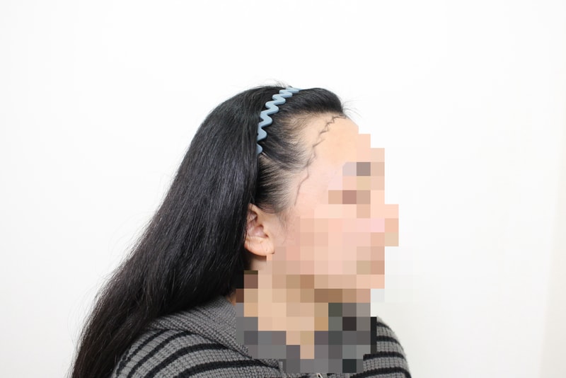★모프로의원★, 헤어라인, 7개월 차