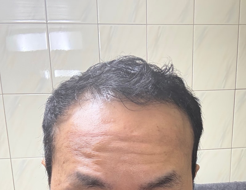 헤어로의원 동탄 절개 모발이식 3500모 10일차 경과