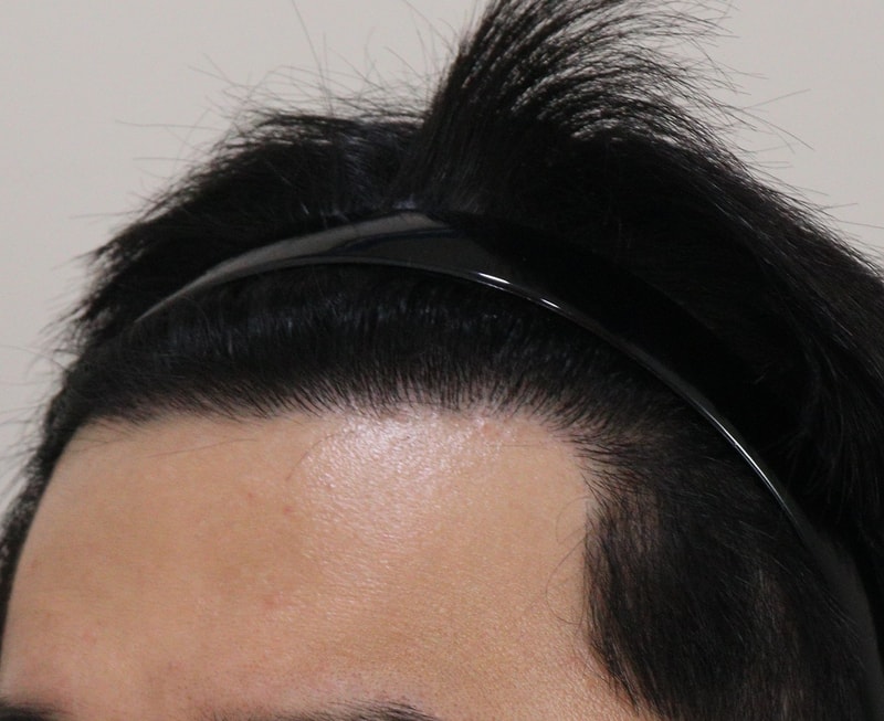 5. 수술후_1년_2.JPG