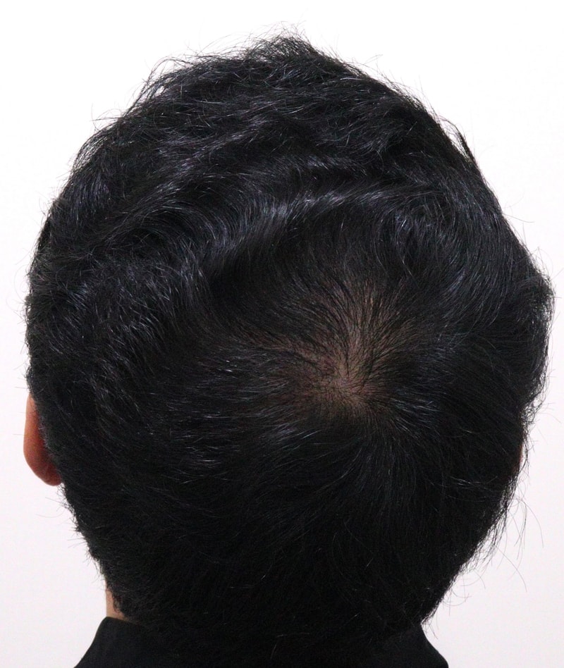 4. 수술후_1년_2.JPG